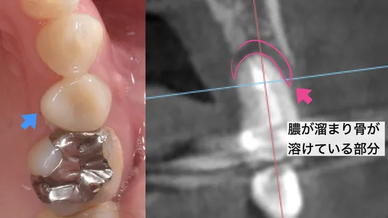 処置をしなかった抜歯部位のCT画像：膿が溜まり骨が溶けている