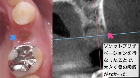 ソケットプリザベーションを行った抜歯部位のCT画像：大きな骨の吸収がない