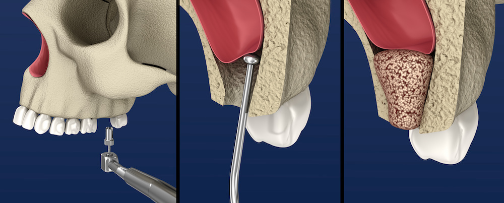 ③上の奥歯のインプラントは上顎洞との距離が短い