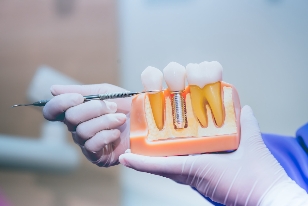 インプラントの人工歯に使用するセラミックの寿命は？