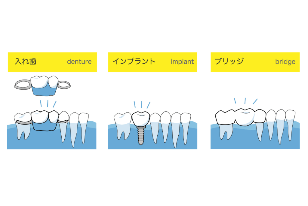 抜歯後の治療法｜ブリッジ・入れ歯・インプラント