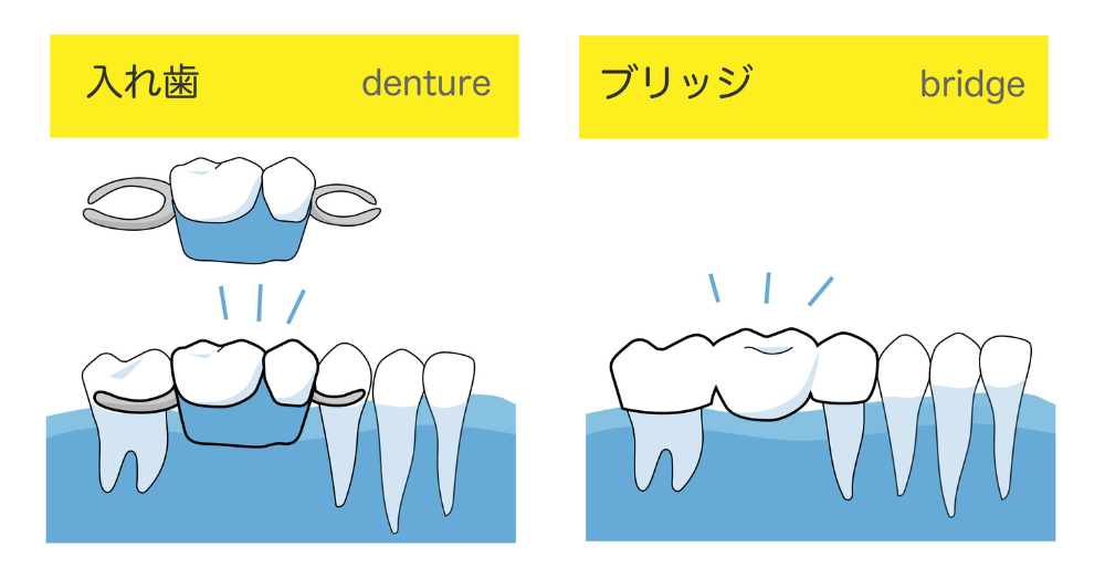 抜歯後の治療法｜入れ歯・インプラント・ブリッジ