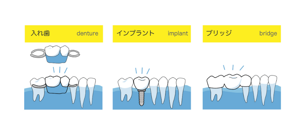 抜歯後の治療法｜入れ歯・インプラント・ブリッジ