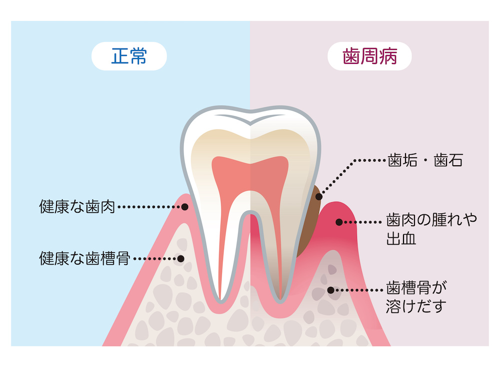 ◾️インプラント治療前の歯周病治療が不十分