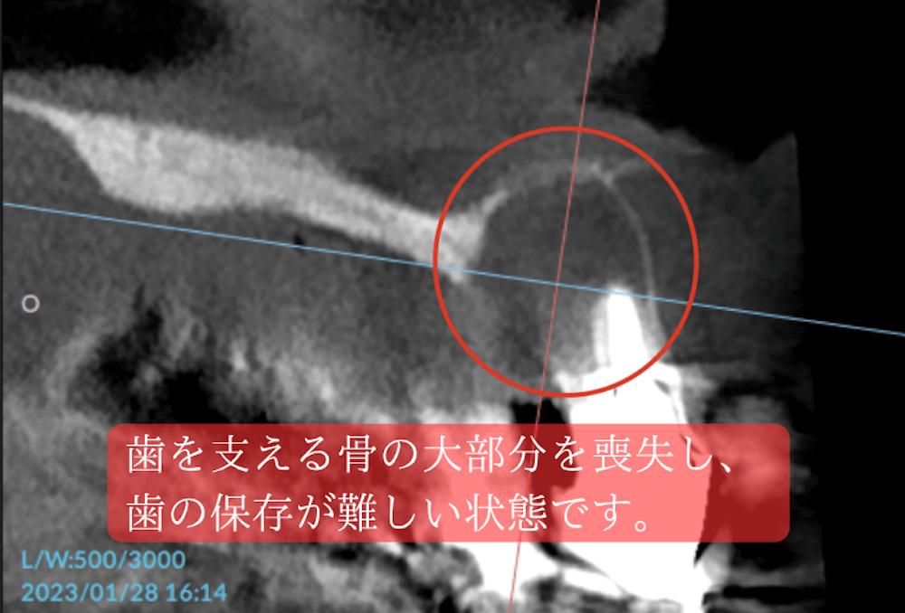 歯を支える骨の大部分を喪失し、歯の保存が難しい状態です。