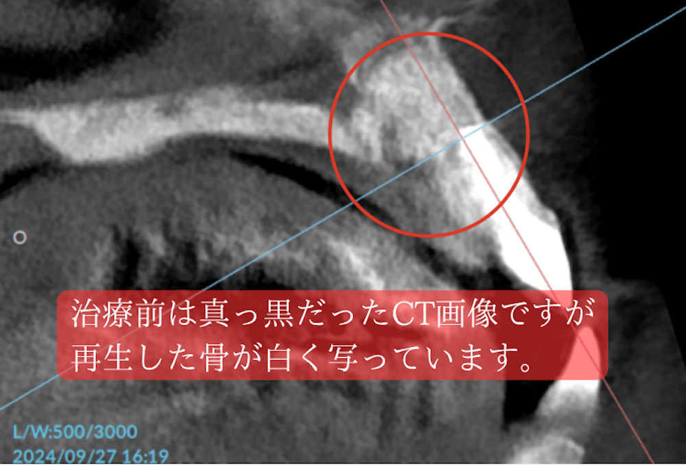 治療前は真っ黒だったCT画像ですが、再生した骨が白く写っています。