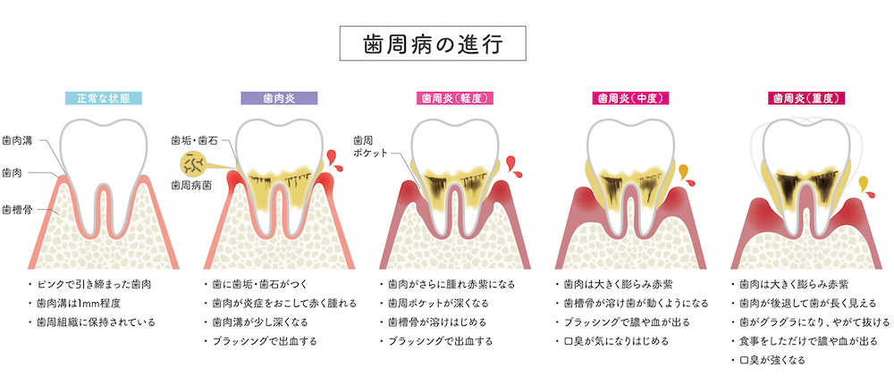 ①重度の歯周病 