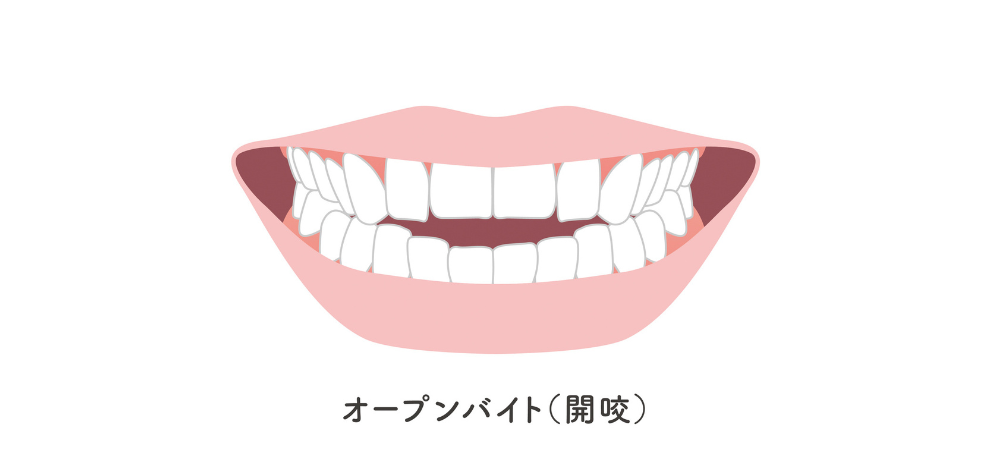 ②開咬（オープンバイト）