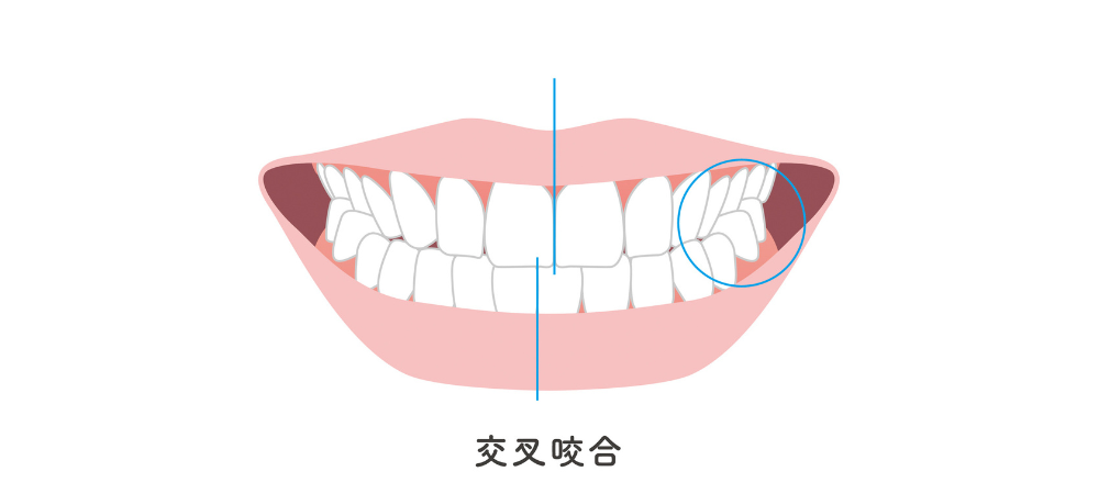 ③交叉咬合（上下の歯の噛み合わせが逆になっている状態）