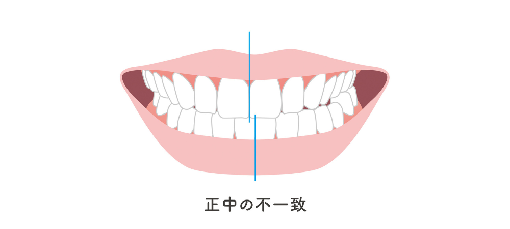⑥正中の不一致