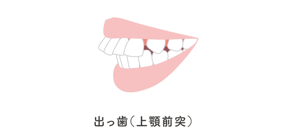 ⑦出っ歯（上顎前突）