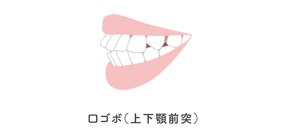 ⑨口ゴボ（上下顎前突）