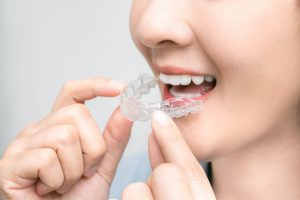 786マウスピース矯正は抜歯矯正できる？抜歯の必要性やデメリット、よくあるご質問にも回答