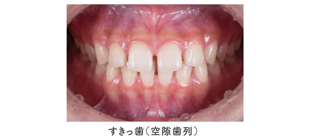 ⑤すきっ歯（空隙歯列）