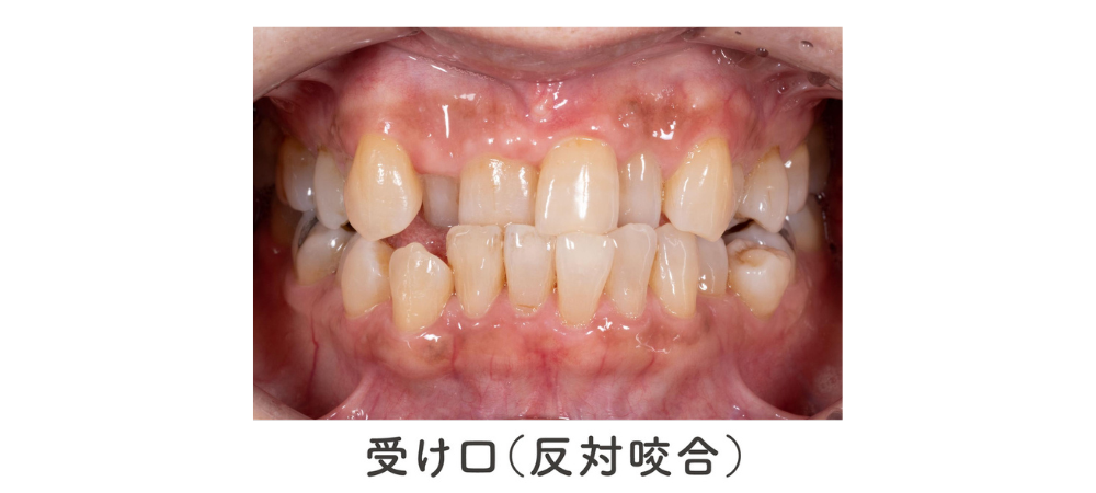 ⑧受け口（下顎前突）