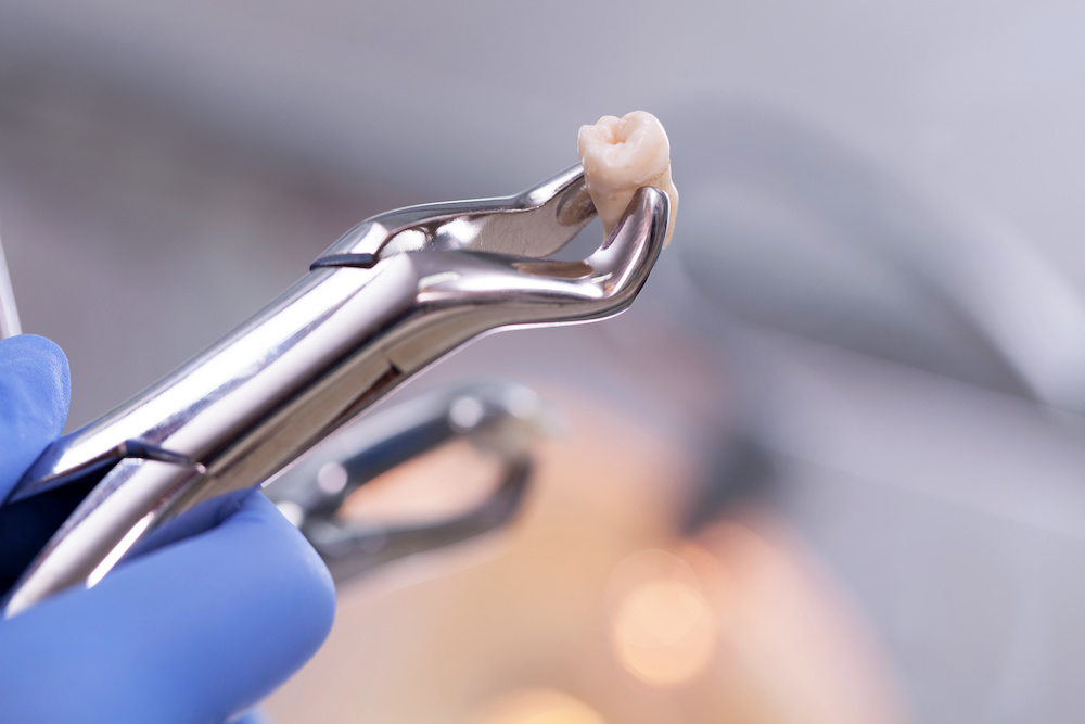 抜歯矯正の場合、抜歯をするタイミングは？同じ医院でできる？