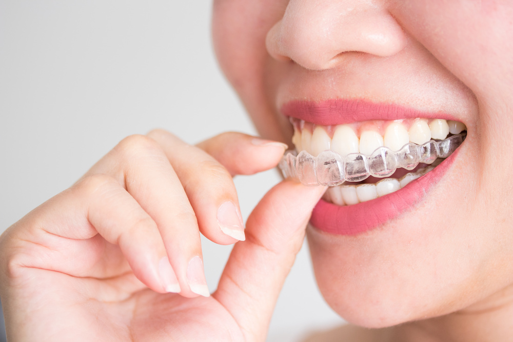 941虫歯があっても歯列矯正はできる？矯正中に虫歯を発症するとどうなる？