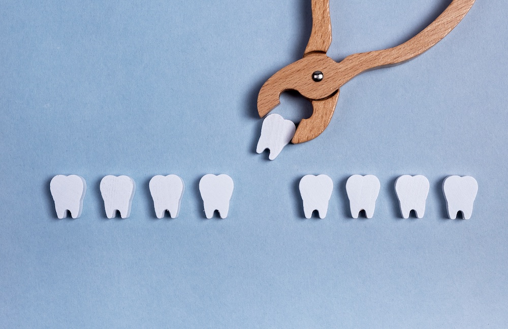 矯正治療で抜歯が必要になる3つの例