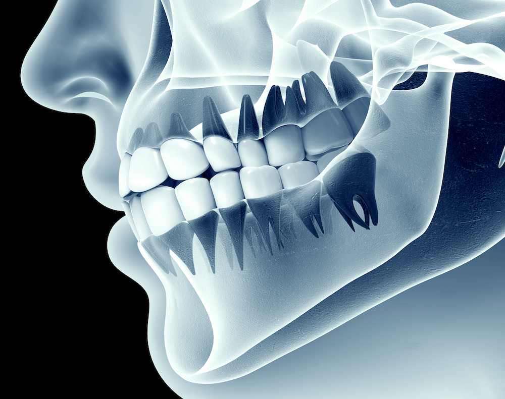 出っ歯の治療③：外科手術（セットバック）