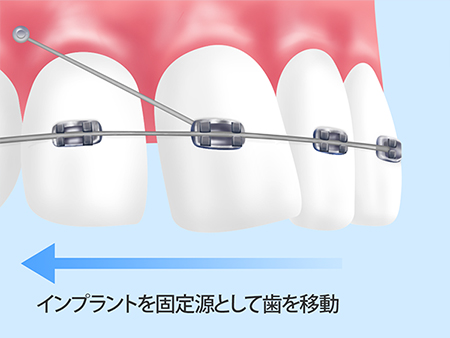 インプラント矯正とは？難症例も治療可能にする最新の矯正治療について