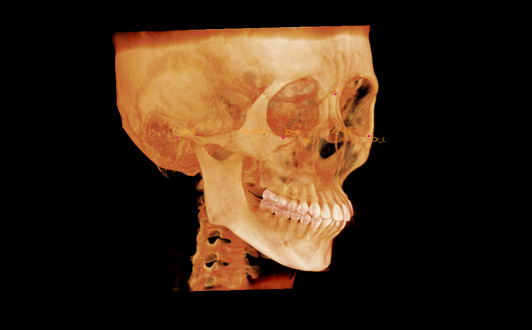前歯部の叢生および上顎前突（前歯のガタガタおよび出っ歯）が気になりご来院されたK.Kさんの相談内容
