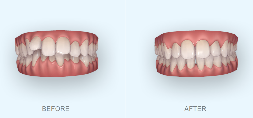 前歯のがたつきと全体的な口元の突出感が気になると来院された方の矯正治療について