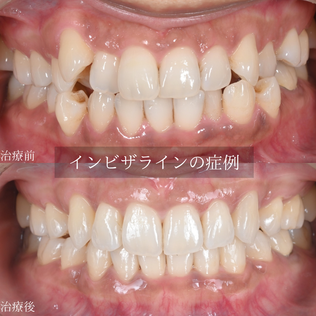 マウスピース矯正で前歯部叢生（八重歯と前歯のガタつき）を治療した症例