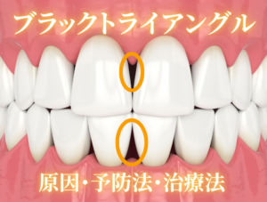 ブラックトライアングルの原因や予防・治療法｜歯列矯正が原因って本当？