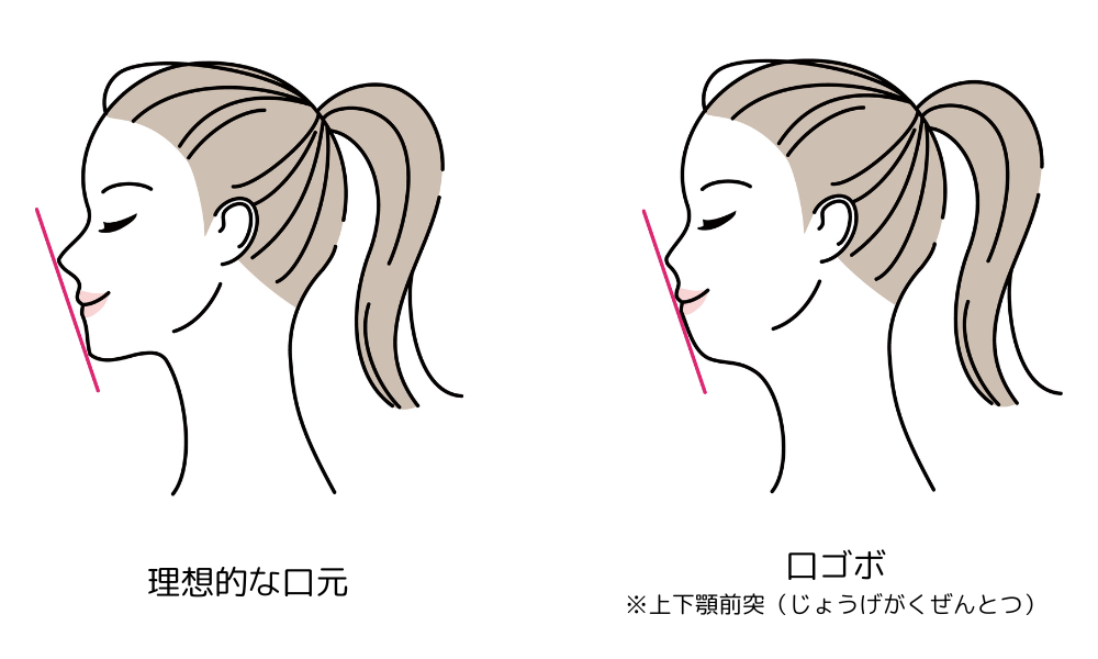 口ゴボとは?