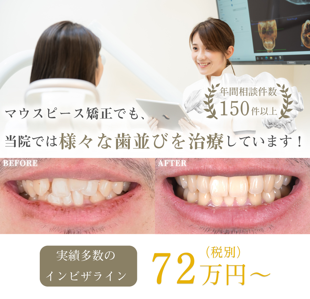 明石でインビザライン（マウスピース矯正）