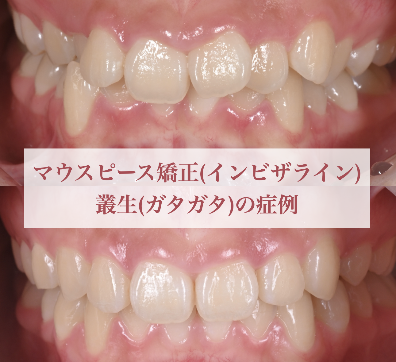 マウスピース矯正(インビザライン) で叢生(ガタガタ)を改善した症例