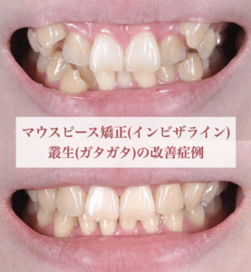 マウスピース矯正(インビザライン) で叢生(ガタガタ)を改善した症例
