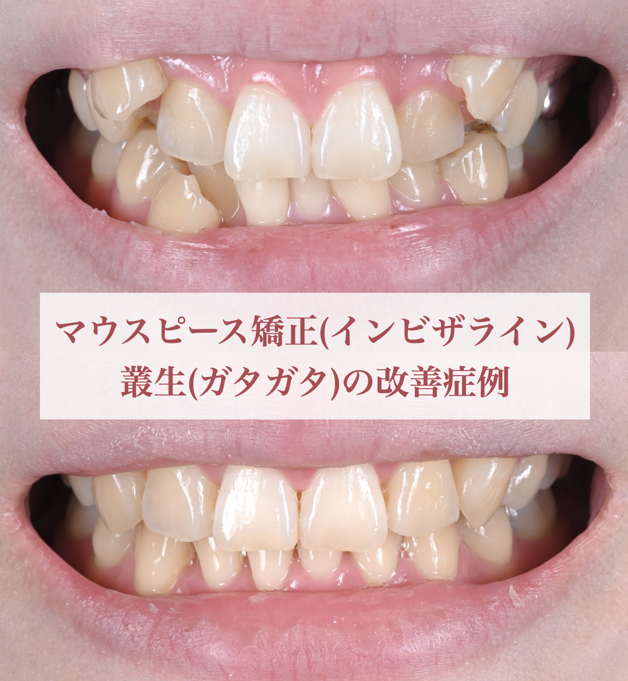 マウスピース矯正(インビザライン) で叢生(ガタガタ)を改善した症例