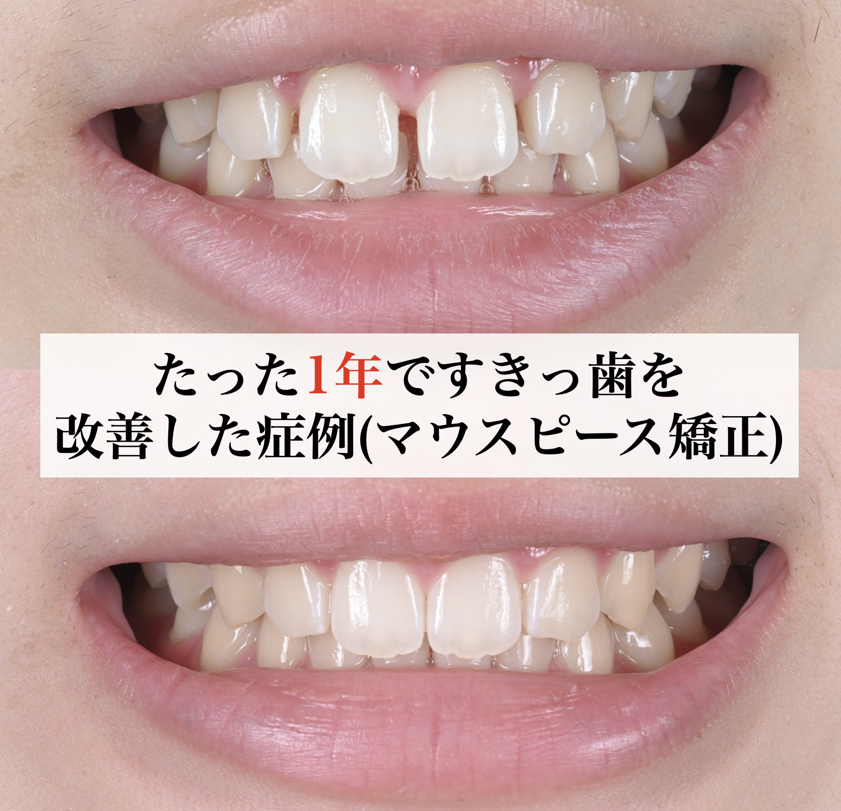 たった一年ですきっ歯を改善した20代女性の症例