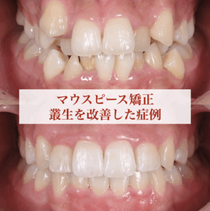 マウスピース矯正で叢生を改善した症例
