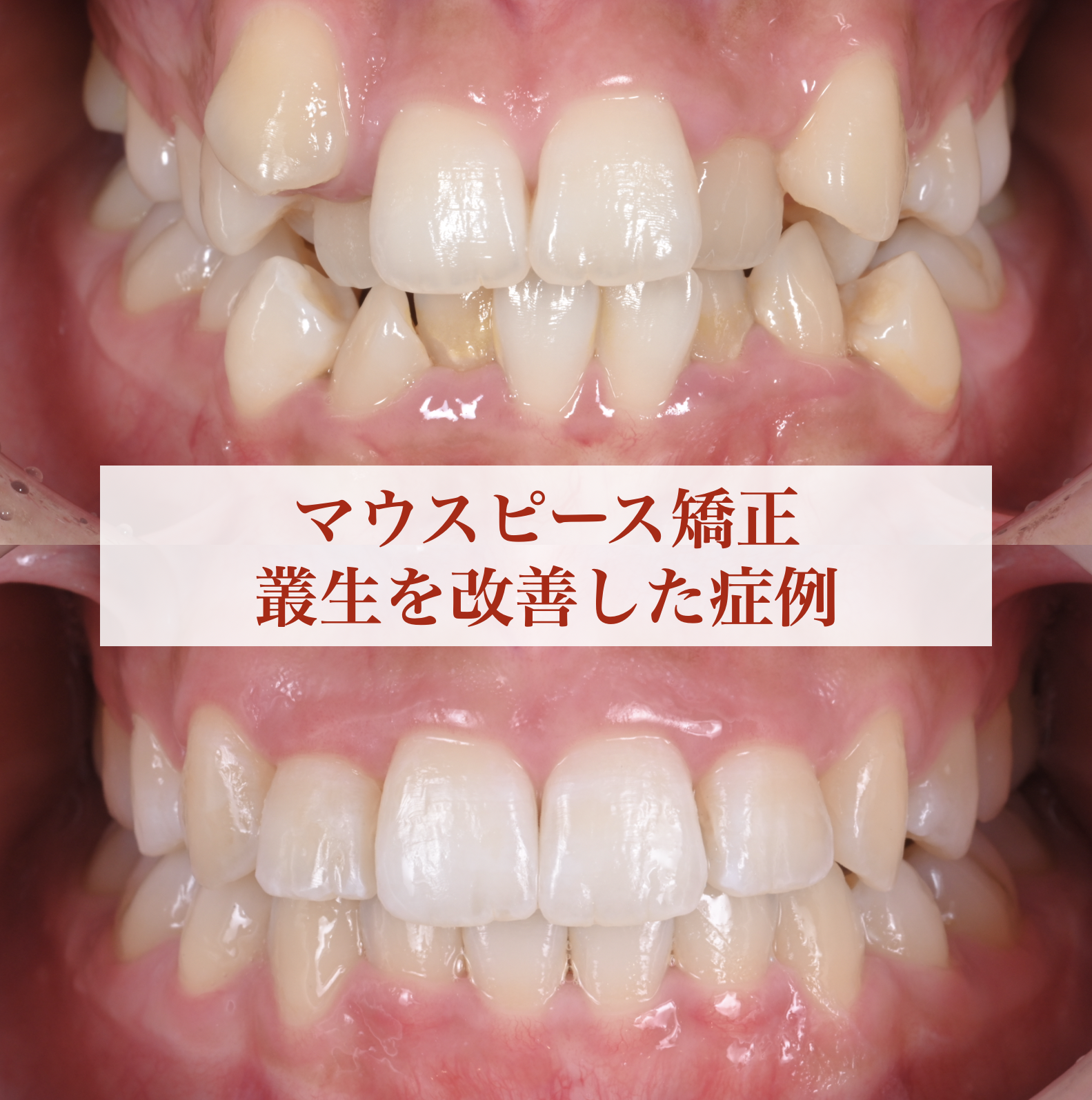 マウスピース矯正で叢生を改善した症例