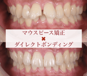 ダイレクトボンディング＆マウスピース矯正