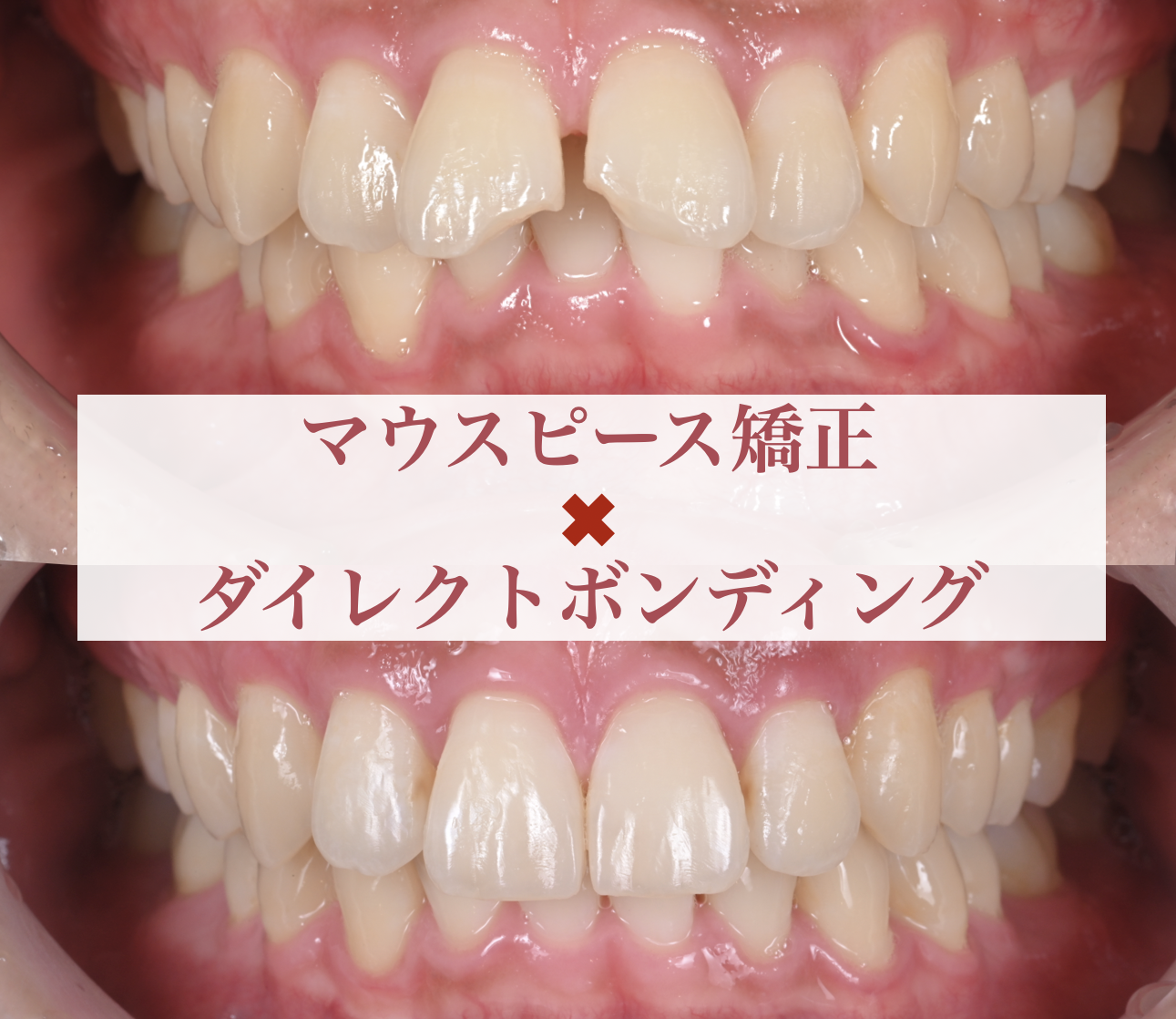 ダイレクトボンディング＆マウスピース矯正