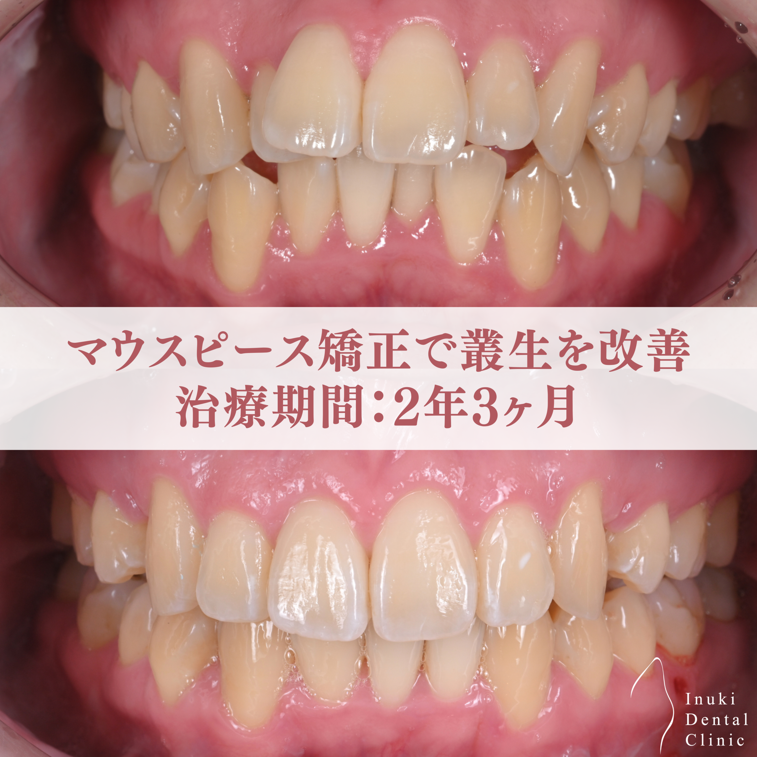 叢生(ガタガタ)を改善したマウスピース矯正症例