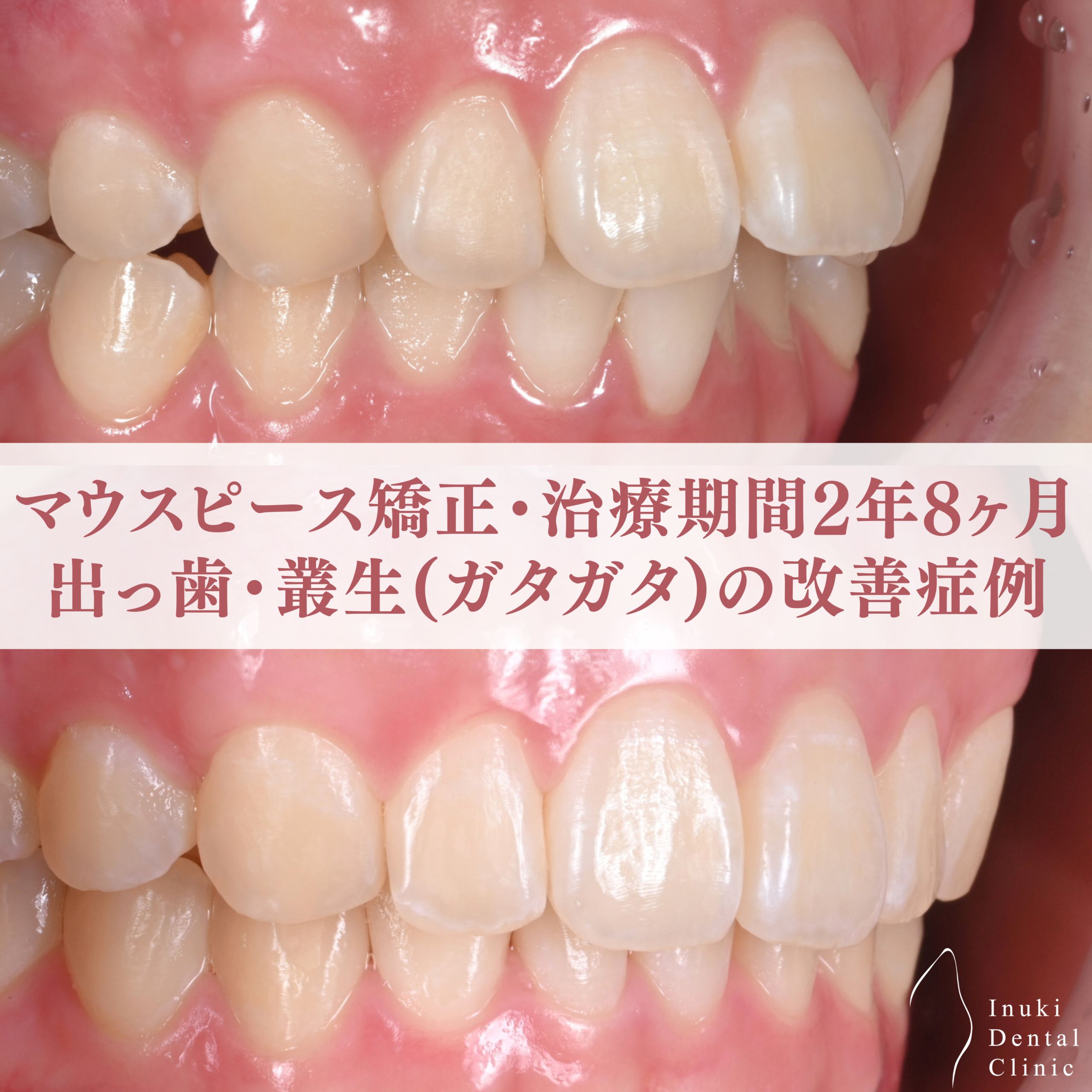 出っ歯・叢生(ガタガタ)を改善したマウスピース矯正症例