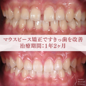 短期間ですきっ歯を改善したマウスピース矯正症例