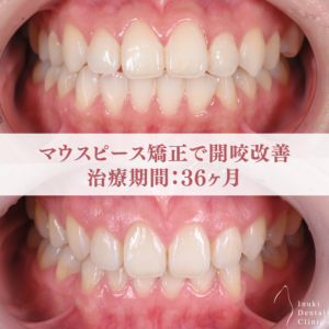 開咬を改善したマウスピース矯正症例