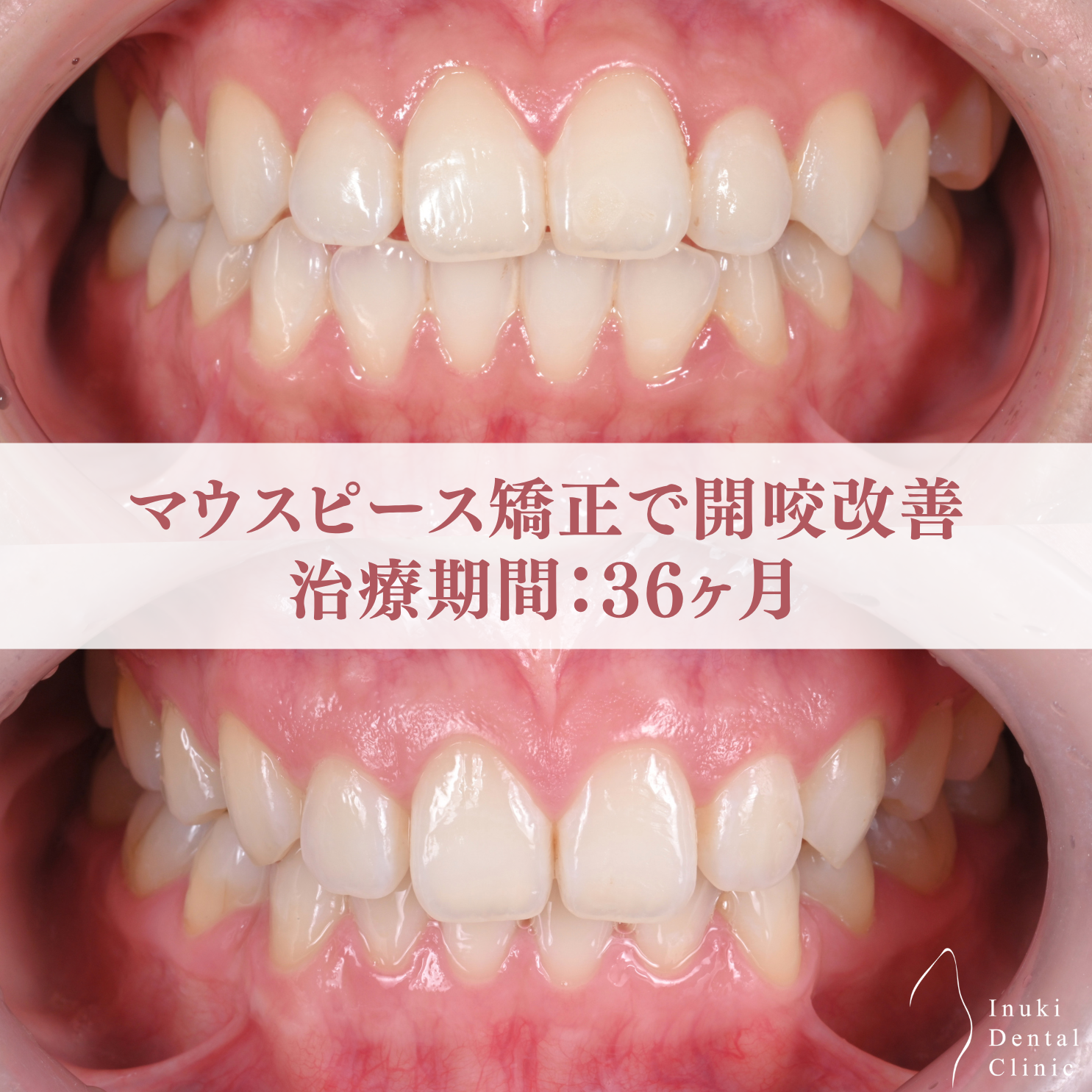 開咬を改善したマウスピース矯正症例