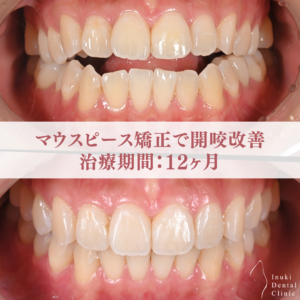 開咬を改善したマウスピース矯正症例