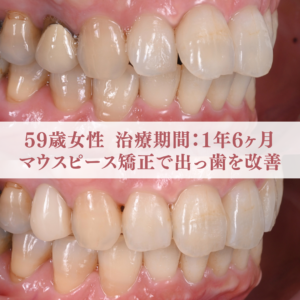 59歳女性 出っ歯を改善した症例