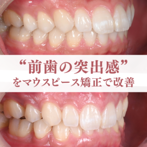 30代男性　上顎前歯の突出感を改善